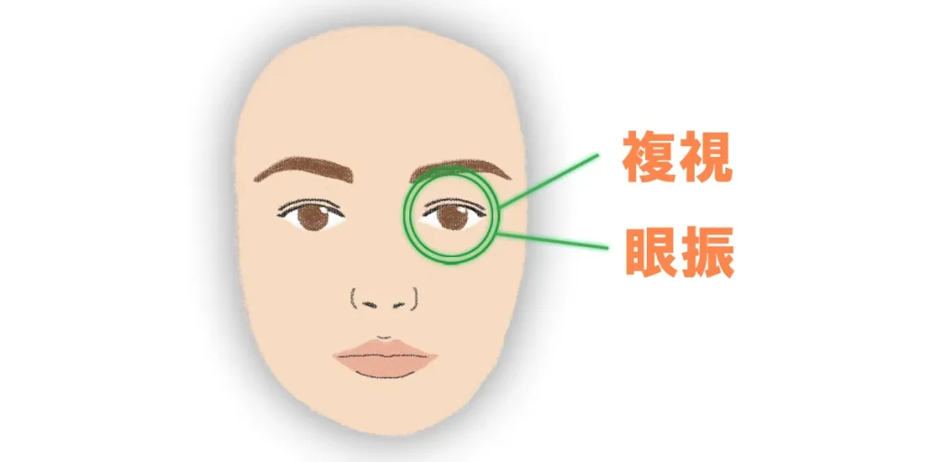 脊髄小脳変性症6型は眼振などが現れやすい