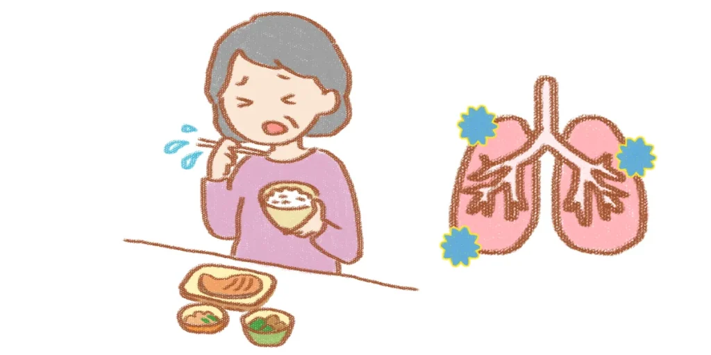 誤嚥性肺炎を現した画像