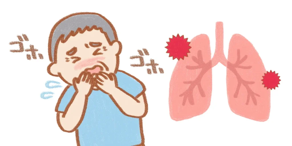 誤嚥性肺炎を引き起こしている画像